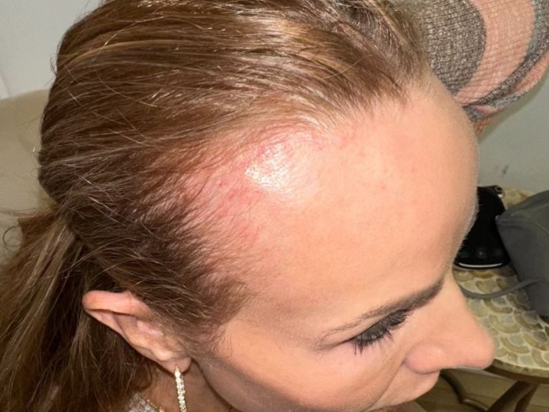 A before pic of Elizabeth Tringali's first Exosomes Therapy for hair