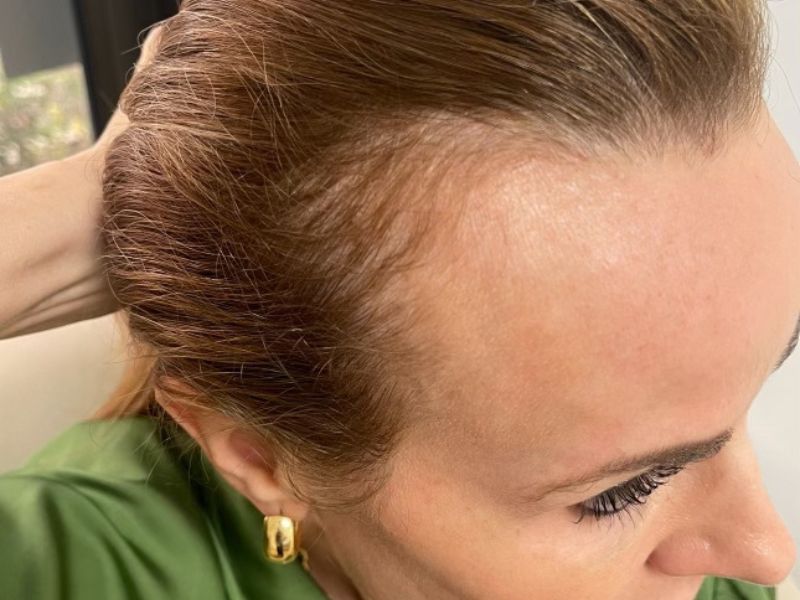 A before pic of Elizabeth Tringali's second Exosomes Therapy for hair