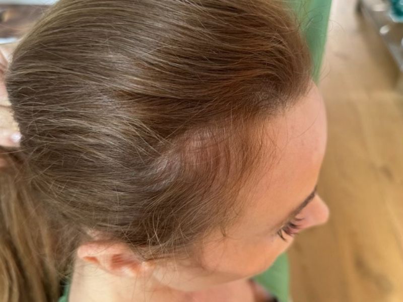 A before pic of Elizabeth Tringali's third Exosomes Therapy for hair