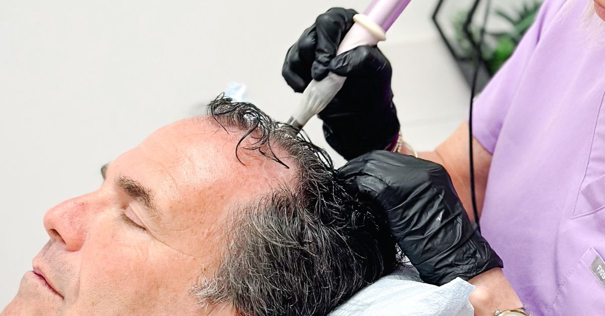 exosomes-therapy-for-hair-loss