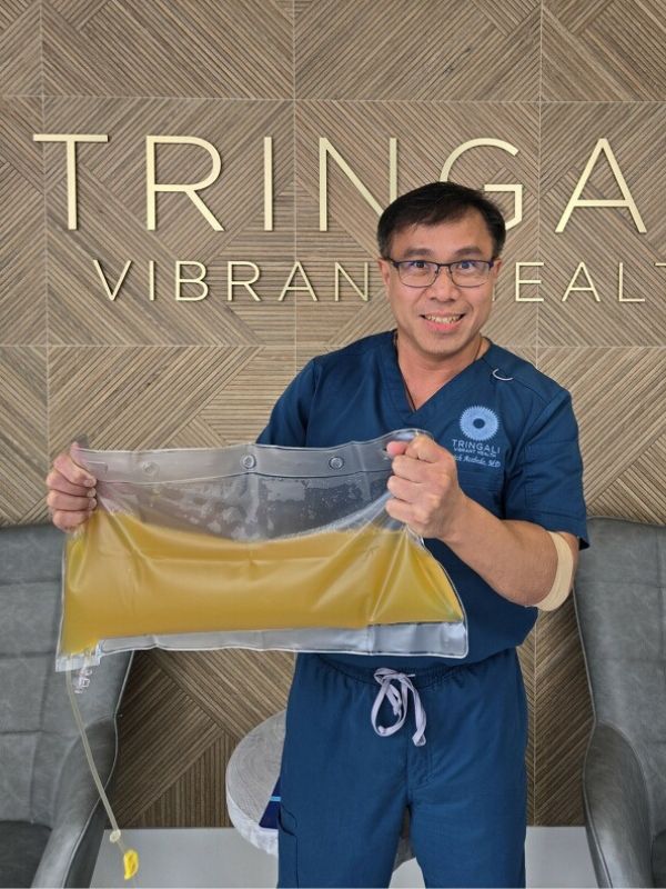 Dr. Erich Acebedo showing his plasma after Therapeutic Plasma Exchange